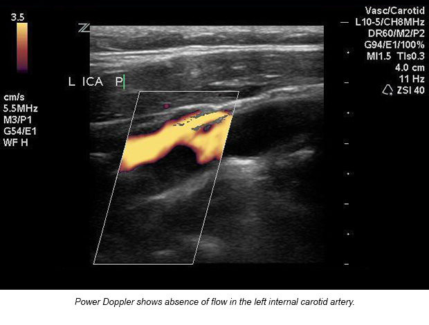 case-study-carotid-artery-01