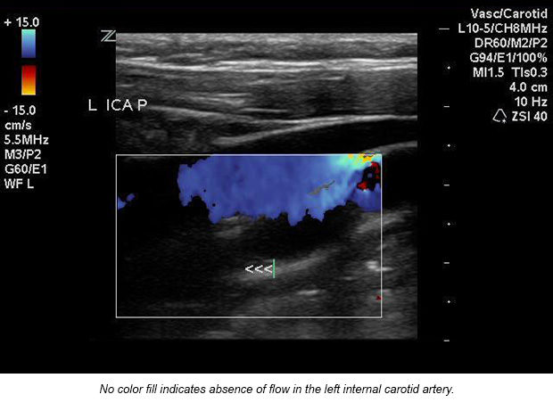 case-study-carotid-artery-02