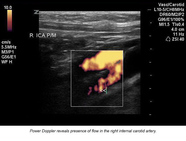 case-study-carotid-artery-03