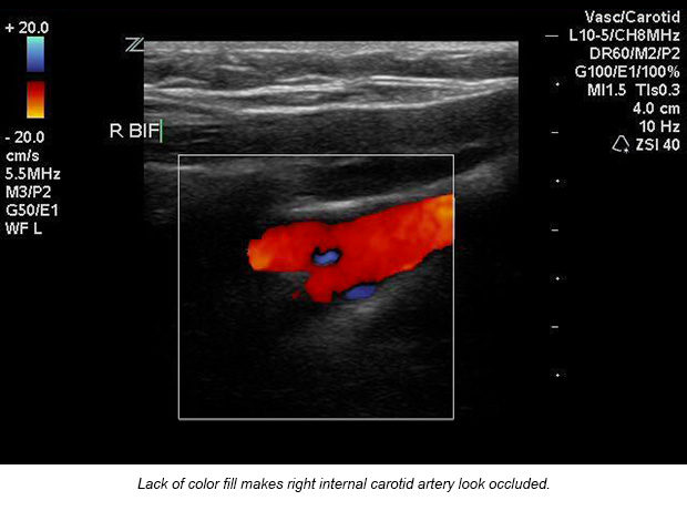 case-study-carotid-artery-04