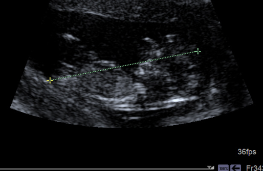 case-study-first-trimester-screen-3