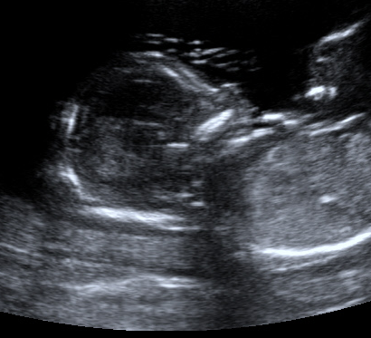 case-study-first-trimester-screen-2