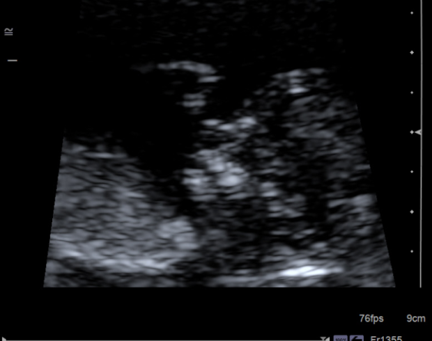 case-study-first-trimester-screen-1